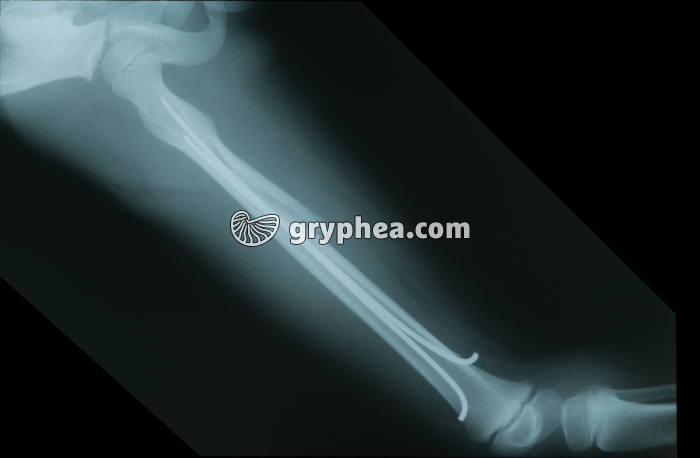 Radiographie de Fémur après opération - gryphea.com
